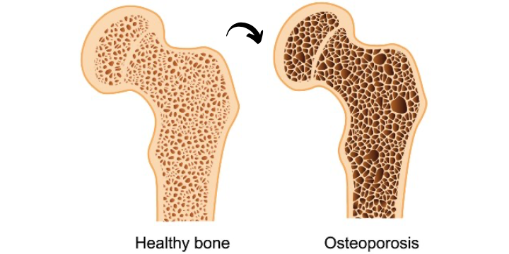 Healthy bone vs osteoporotic bone structure.